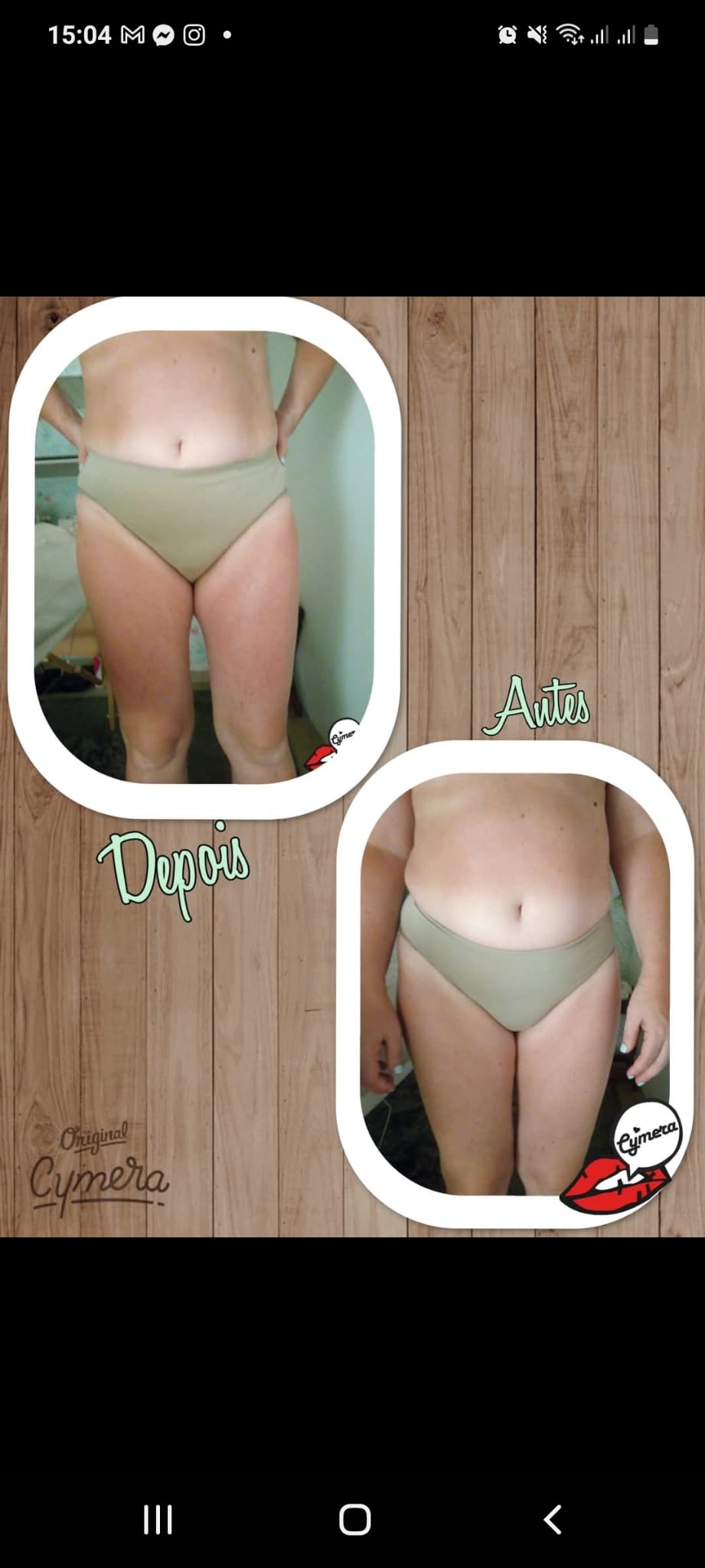 Antes e Depois - Tratamento Estético